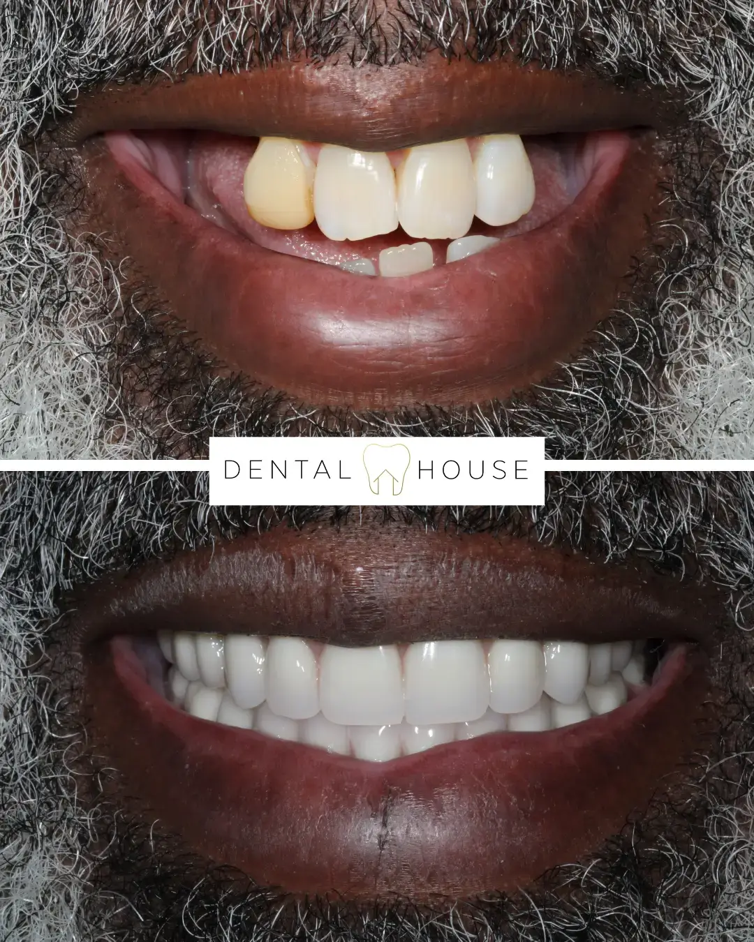 Dental House patient before and after full-arch implant treatment