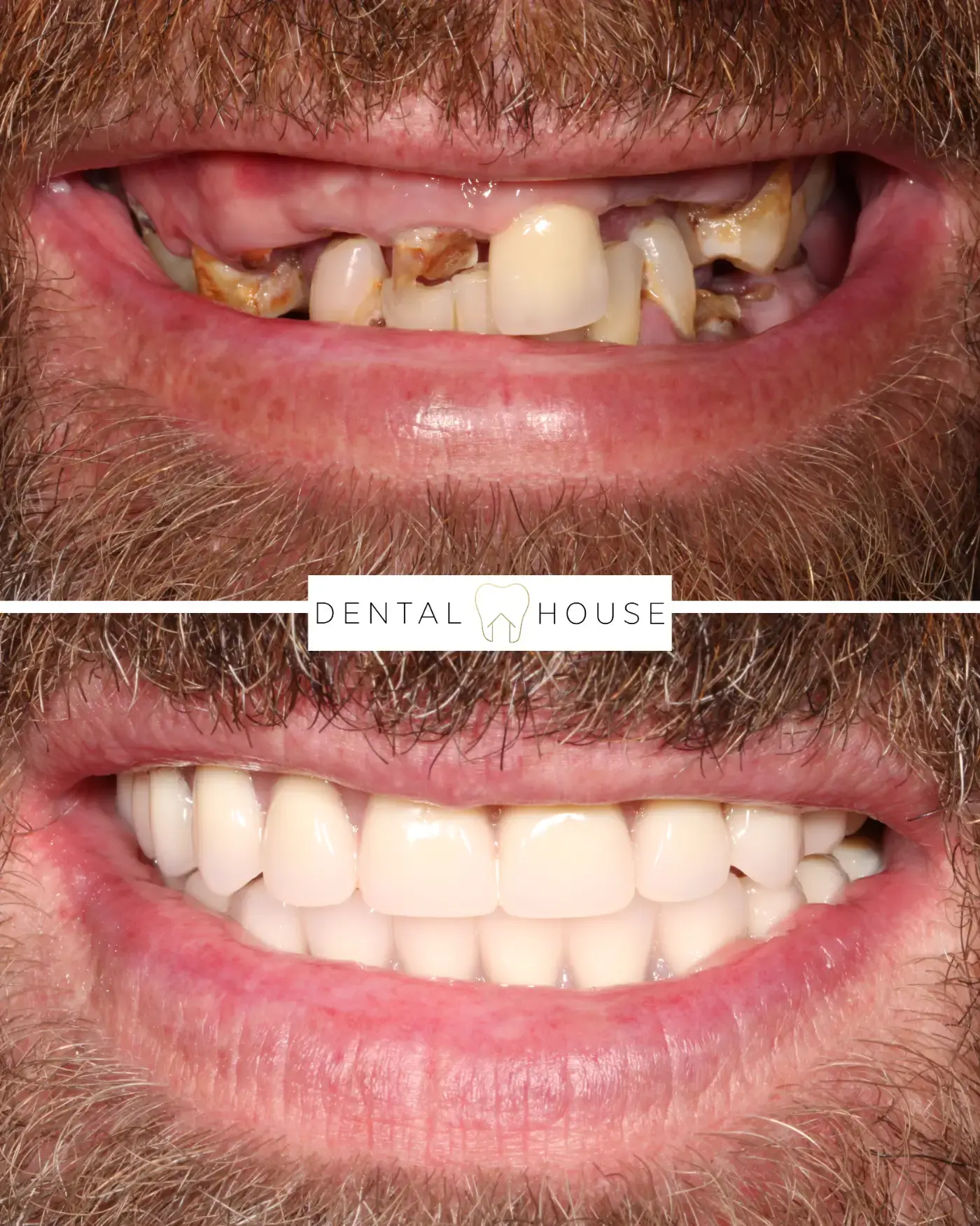 Dental House patient before and after full-arch implant treatment