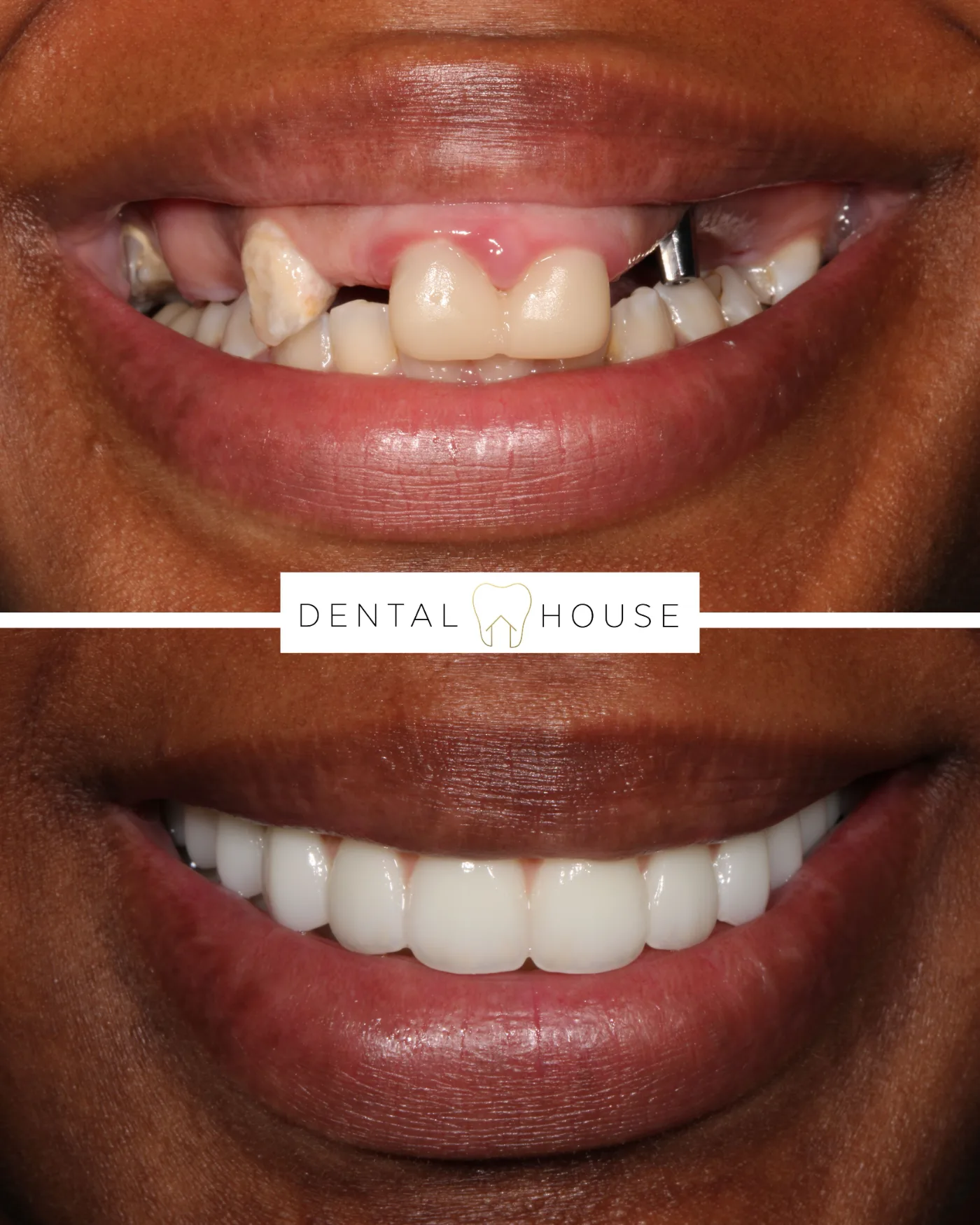 Dental House patient before and after full-arch implant treatment