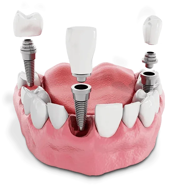 Single tooth dental implant model